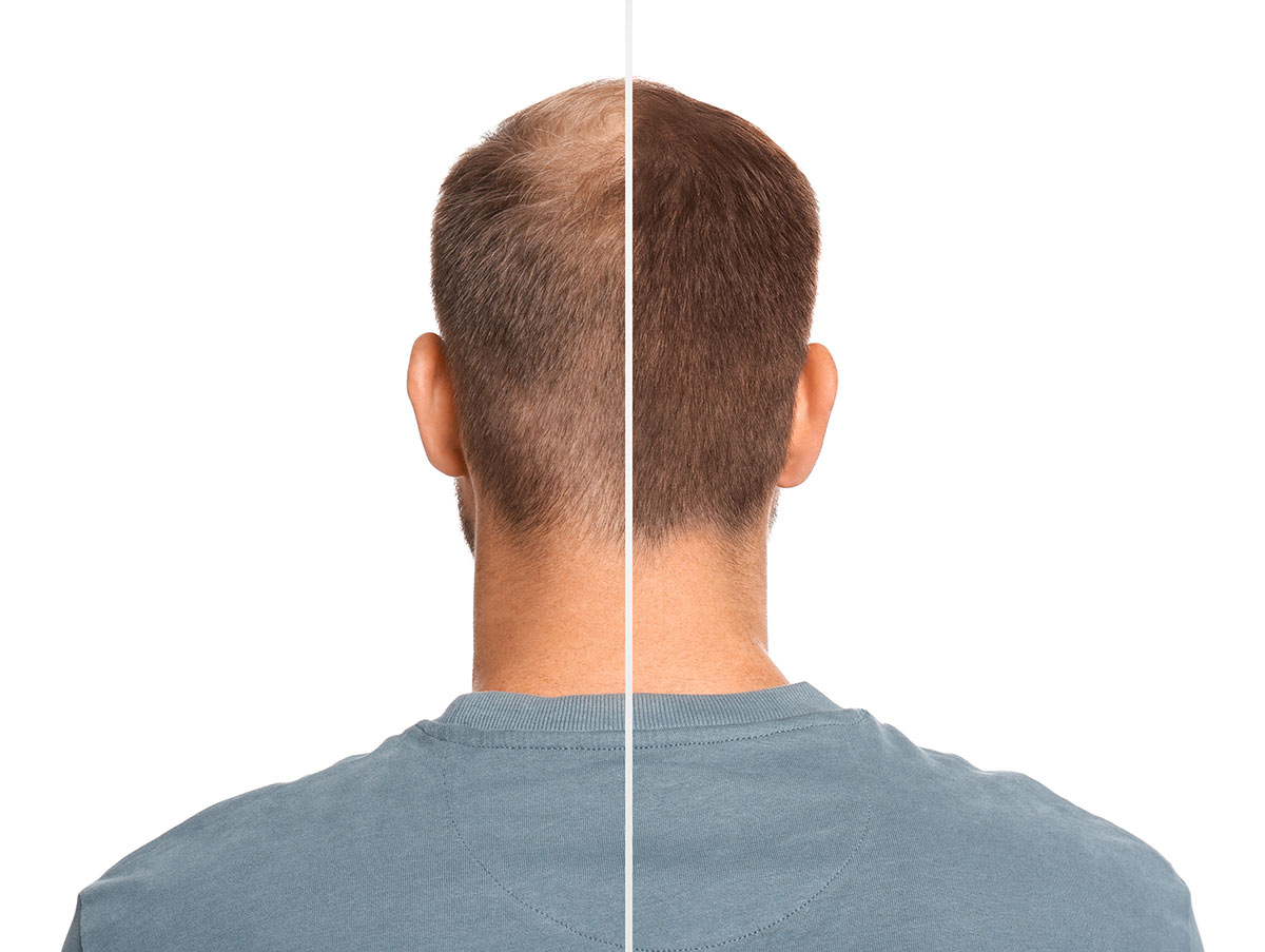 Direct Hair Implantation