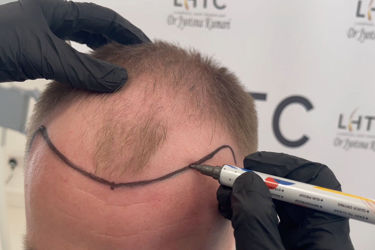 DHI Hair Transplant